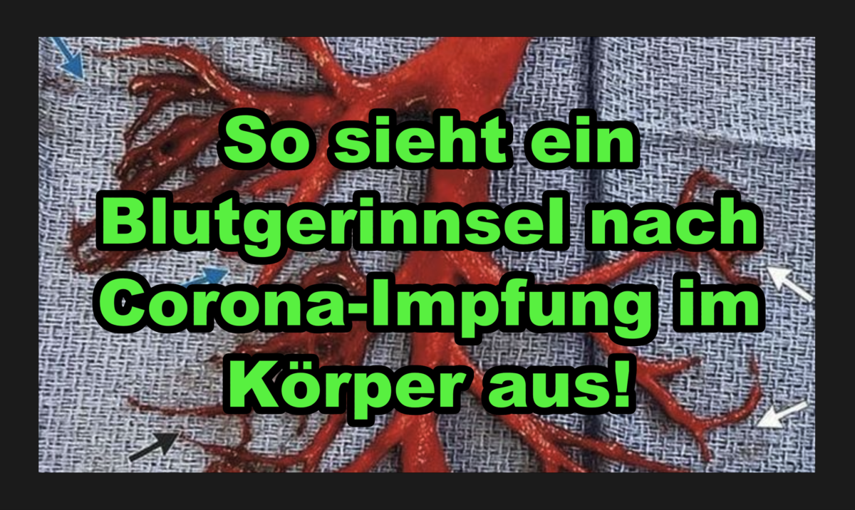 Gerinnselschusswarnung: So sieht ein Blutgerinnsel nach Corona-Impfung im Körper aus!