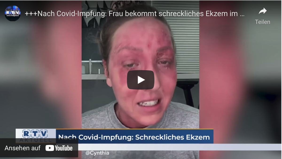 +++Nach Covid-Impfung: Frau bekommt schreckliches Ekzem im Gesicht+++