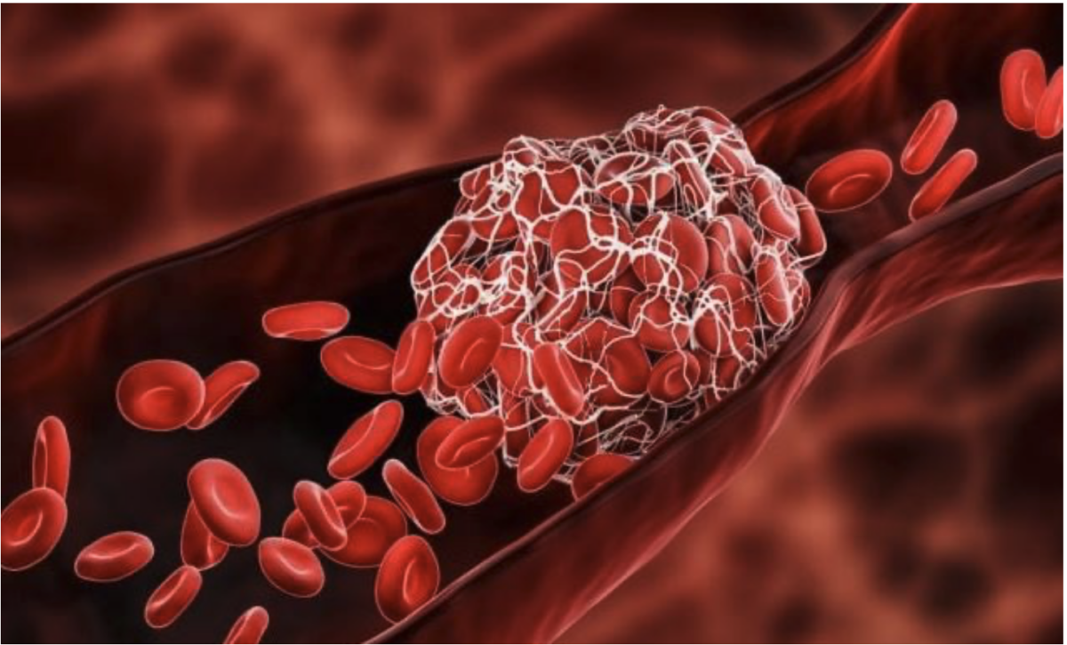 COVID-Impfstoffe sind jetzt definitiv mit Menstruationsstörungen, Blutzellmangel, Tinnitus, Muskel-Skelett-Problemen und Ohrerkrankungen verbunden