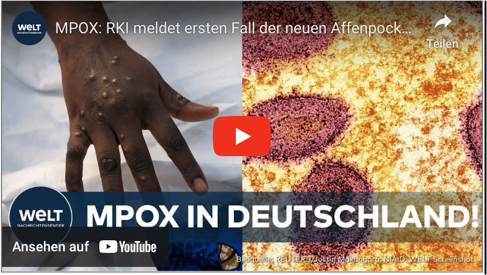 MPOX: RKI meldet ersten Fall der neuen Affenpocken-Variante in Deutschland!
