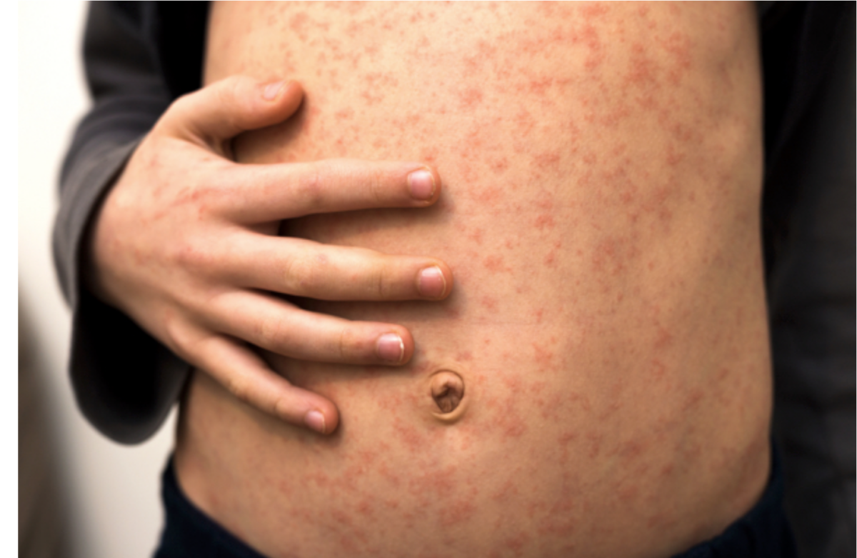 MASERHYSTERIE: Eine hergestellte Krise, um die Gewinne von Big Pharma voranzutreiben