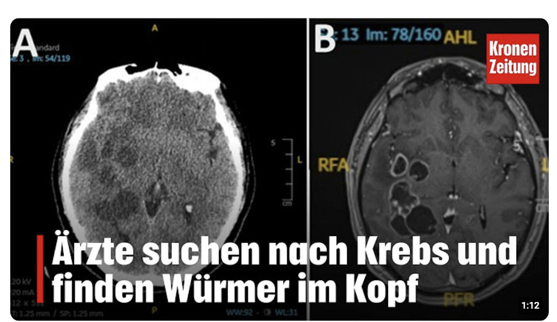 Ärzte suchen nach Krebs und finden Würmer im Kopf | krone.tv NEWS