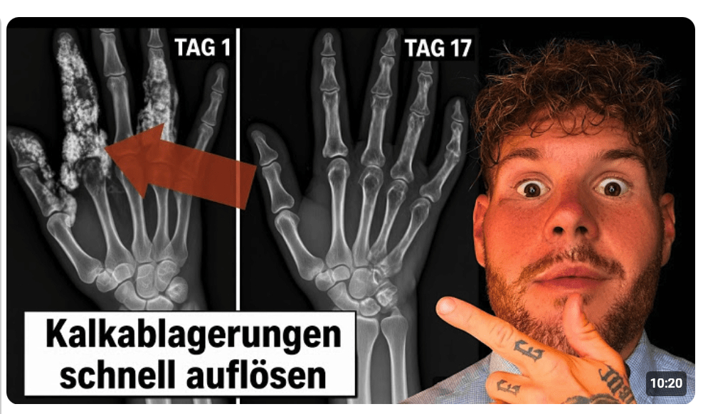 Weichteilverkalkung Umkehren: Calcium aus dem Gewebe zurück in die Knochen holen