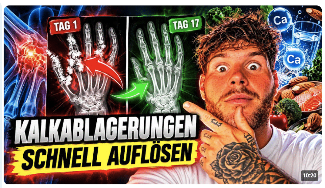 Weichteilverkalkung Das unterschätzte Gesundheitsproblem